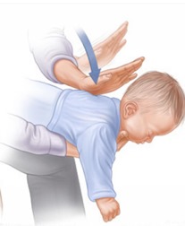 Manobra de Heimlich sendo realizada em bebê